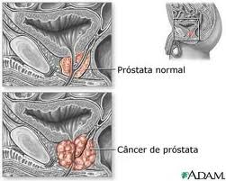 cancer de prostata