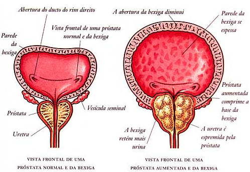 prostata2