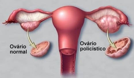 Terapia de reposição hormonal na menopausa: Fato ou Fake? - Simone Neri